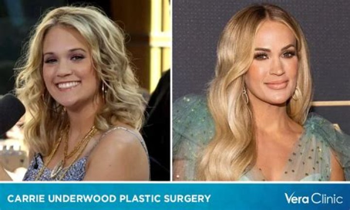 Carrie Underwood Plastic Surgery: Unveiling the Truth Behind the Transformation