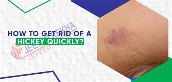 How to Hide a Hickey: Effective Tips and Tricks for Quick Concealment