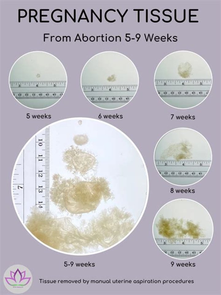 Miscarriage Tissue Pictures at 6 Weeks: Understanding, Identification, and Emotional Support