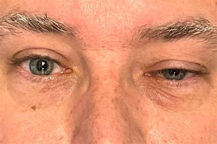 Steve Liesman Eye Injury Update: What We Know So Far