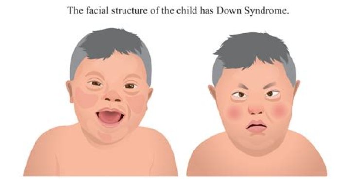 Which Kelce Daughter Has Down Syndrome: A Comprehensive Guide for Parents and Families